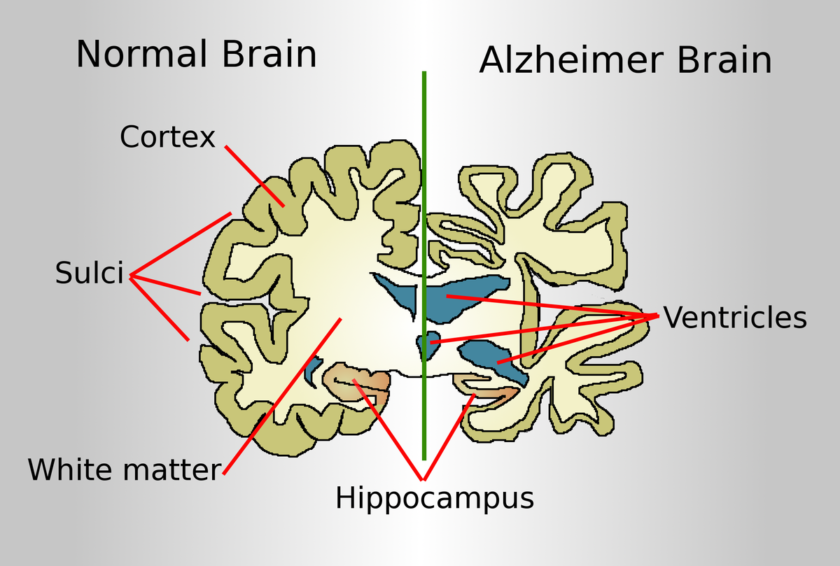 Alzheimer’s